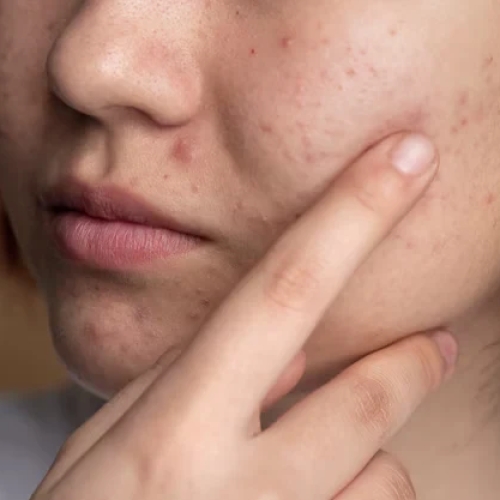 Як позбутися сірої тьмяної шкіри без агресивних пілінгів