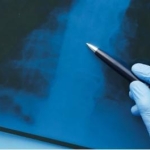 Перелом хребта: ступені тяжкості, лікування та реабілітація