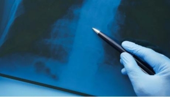 Перелом хребта: ступені тяжкості, лікування та реабілітація